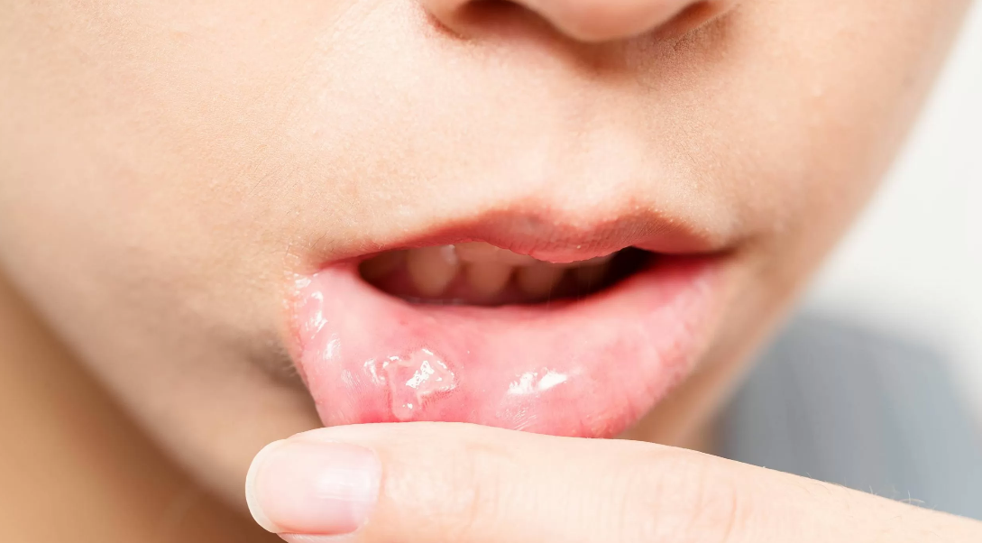 Mouth Ulcers