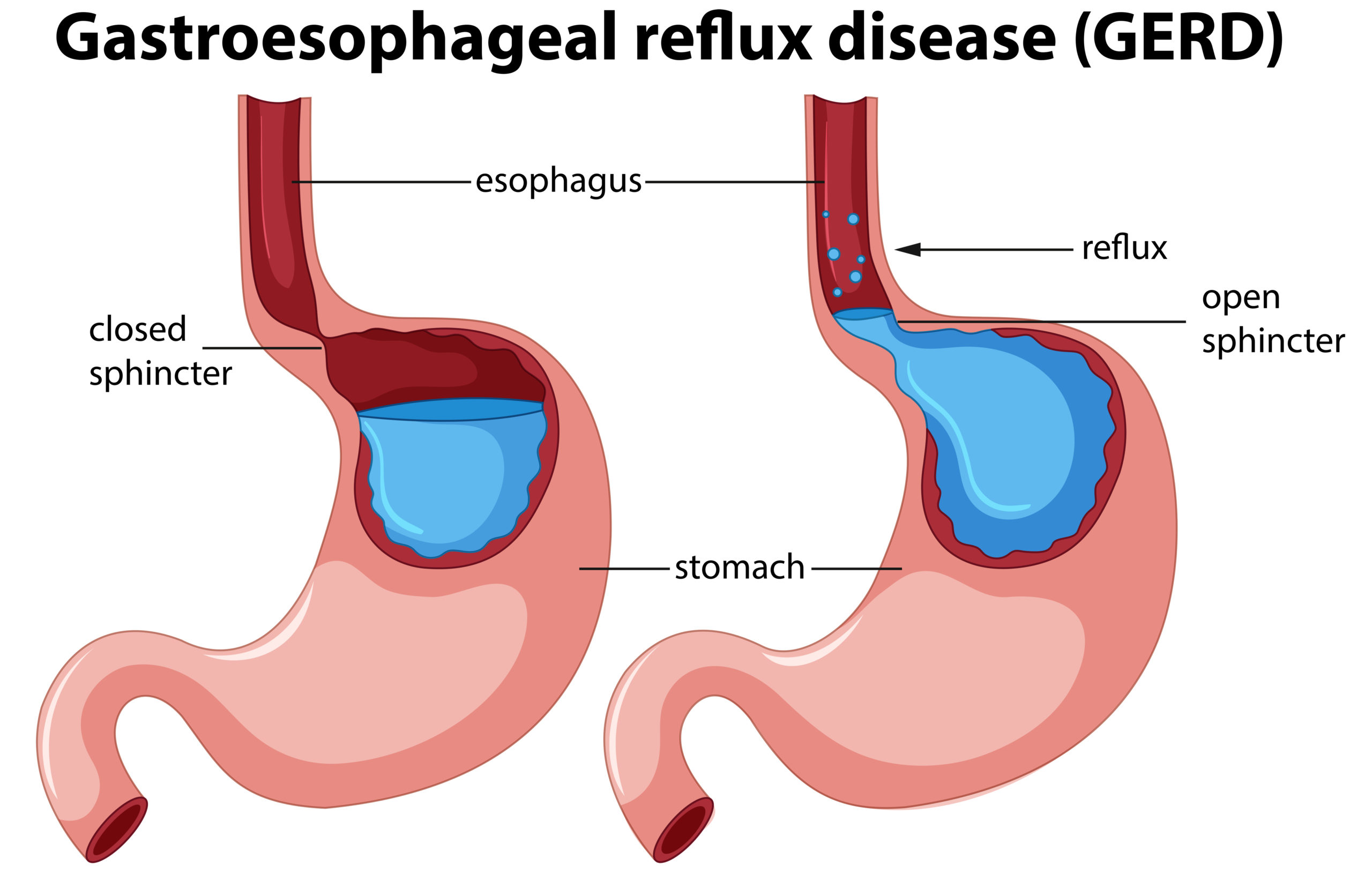 GERD Gastroesophageal reflux disease Tambaram Medical Center