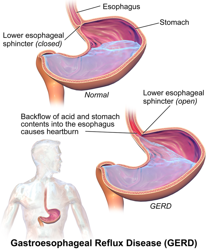 gerd-gastroesophageal-reflux-disease-tambaram-medical-center