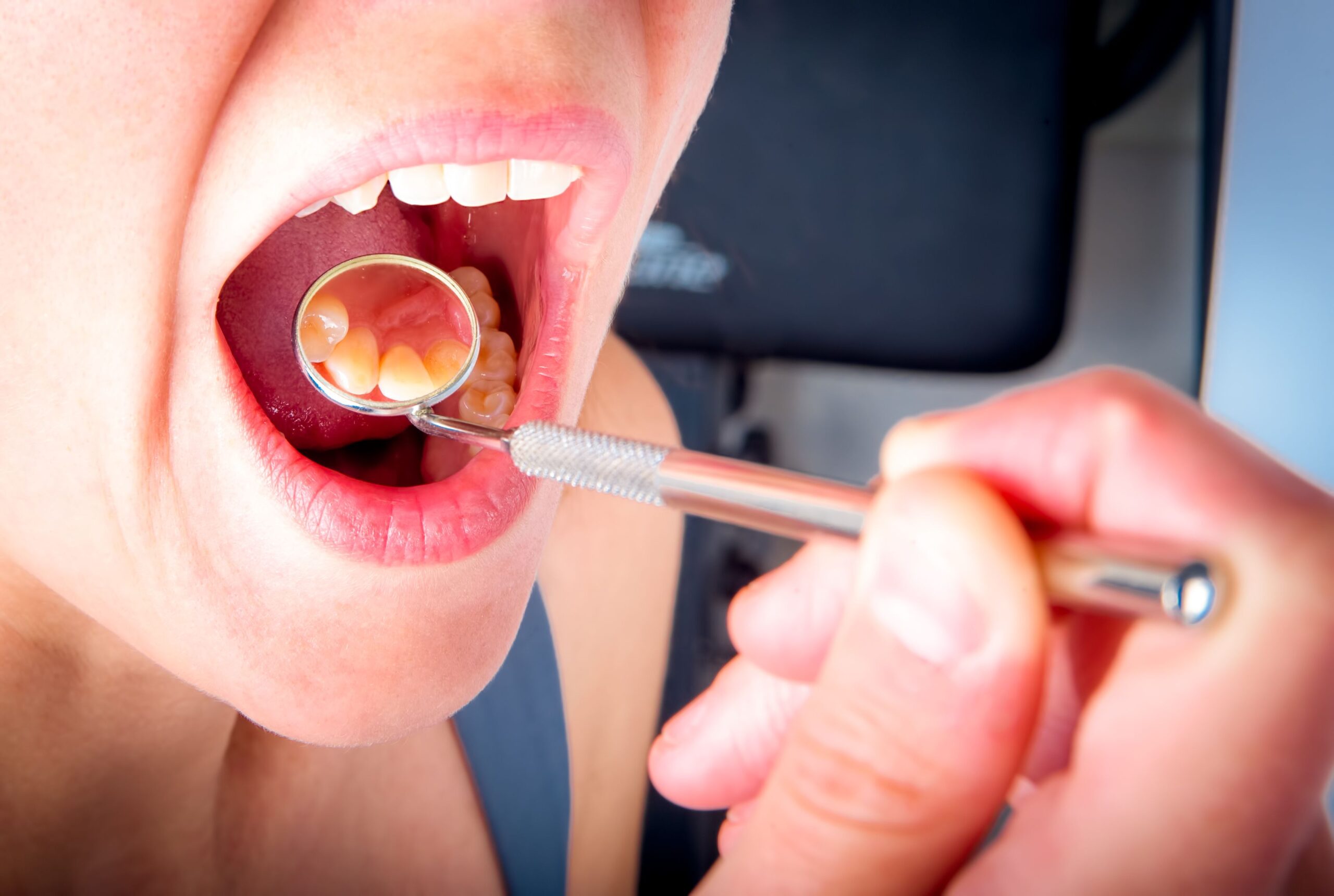 Recurrent Aphthous Stomatitis – Mouth and Dental Disorders