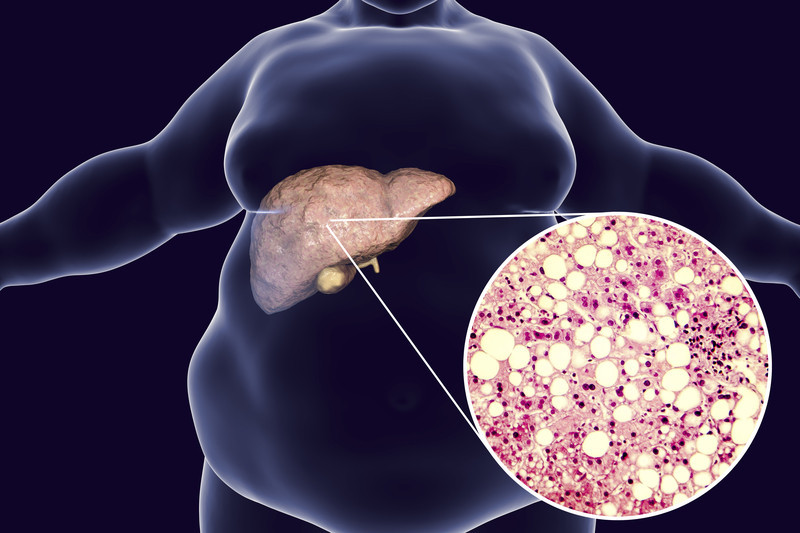Fatty Liver Disease: Everything You Need to Know
