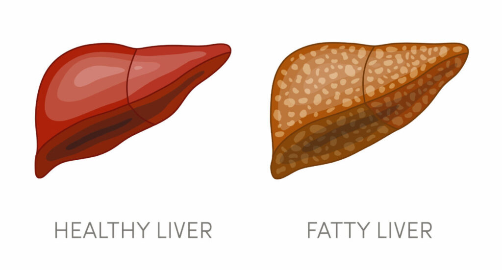 fatty-liver-disease-everything-you-need-to-know-tambaram-medical-center