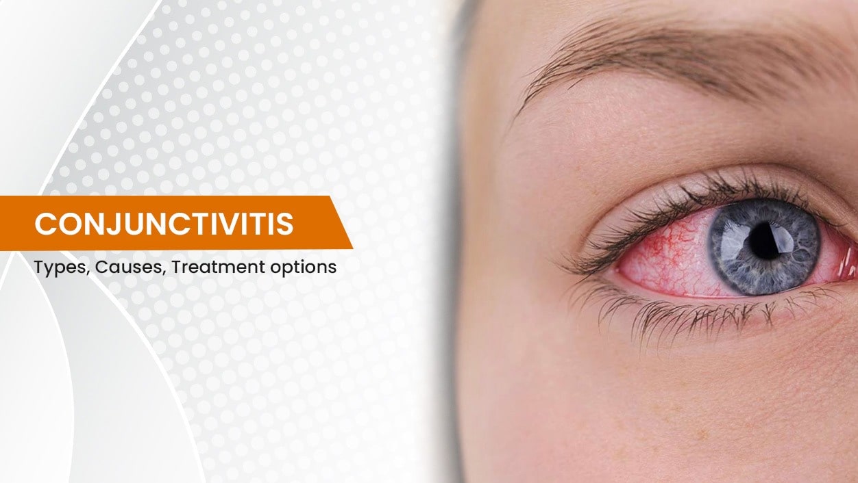 Conjunctivitis: Types, causes, treatment options