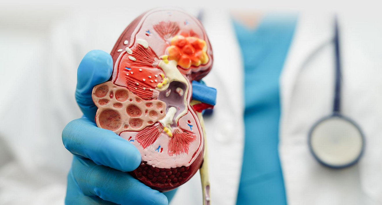 Chronic kidney disease stages infographic showing CKD stage 1 to stage 5