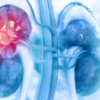 Diabetes causing kidney damage diabetic nephropathy
