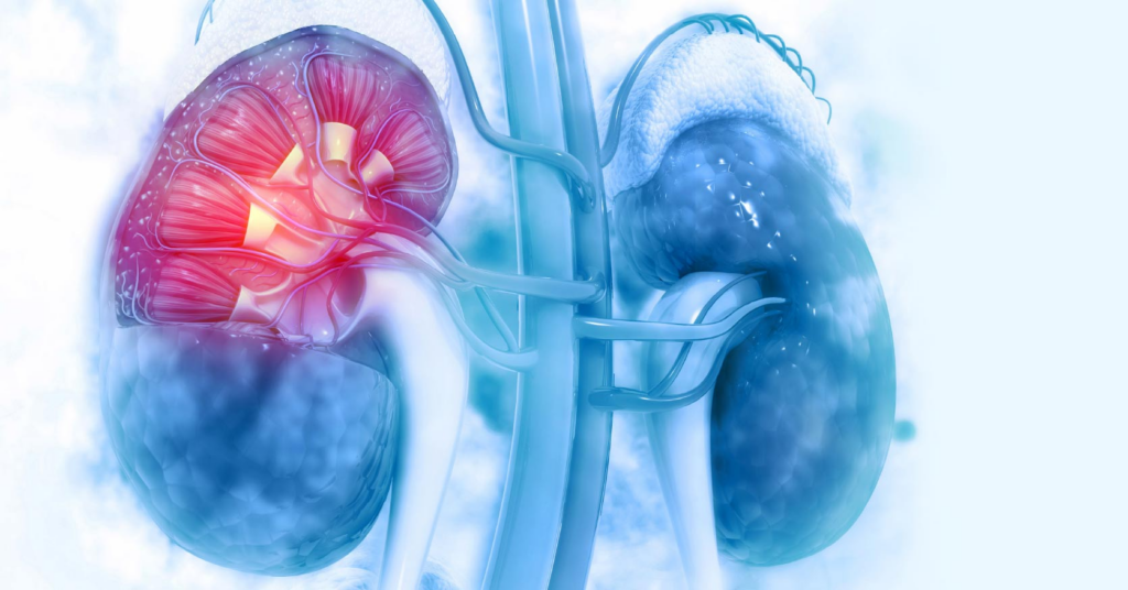 Diabetes causing kidney damage diabetic nephropathy