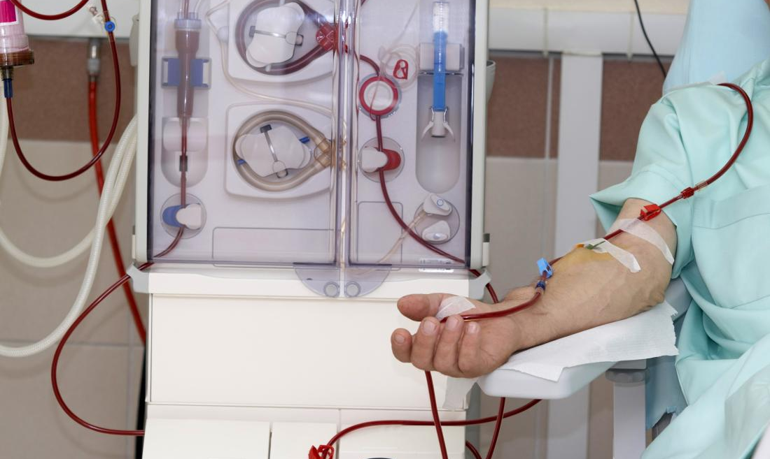 Dialysis procedure infographic showing hemodialysis and peritoneal dialysis